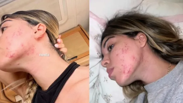 
                    Isabela Cardinali mostra estado do rosto (que escondeu) após divórcio
                