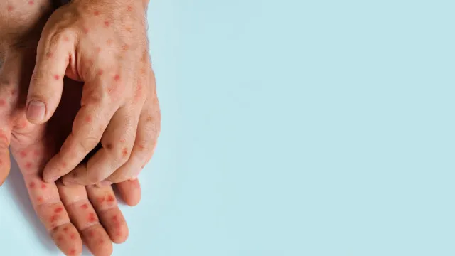 Mpox em Portugal. Os sintomas e como proteger-se do vírus