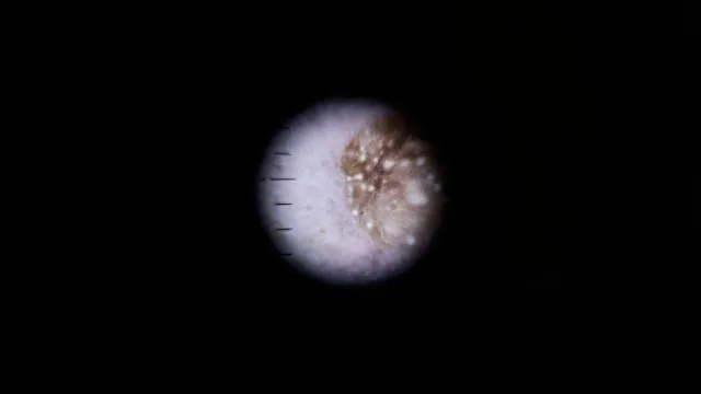 
                    Novo passo contra o melanoma: Investigadores em Portugal criam hidrogel
                