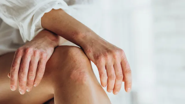 
                    Psoríase. Má higiene é a causa? Só afeta a pele? Dermatologista esclarece
                