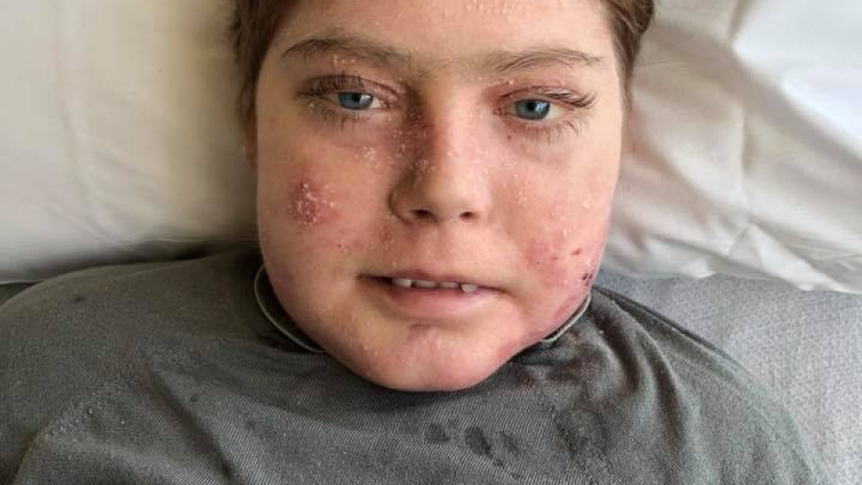 Morreu Jonathan Pitre, a "criança borboleta". Tinha 17 anos