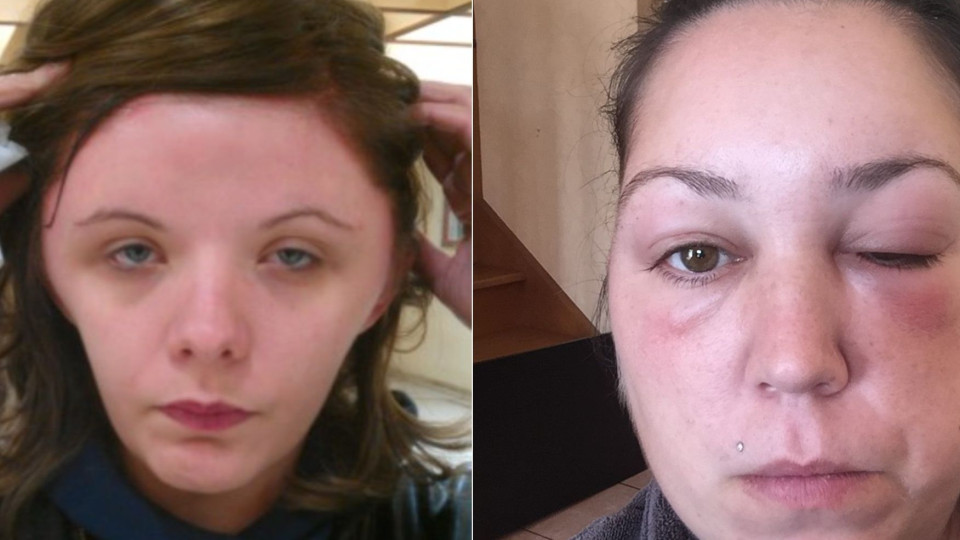 Alergia a tinta de cabelo: Após Estelle, outras mulheres denunciaram