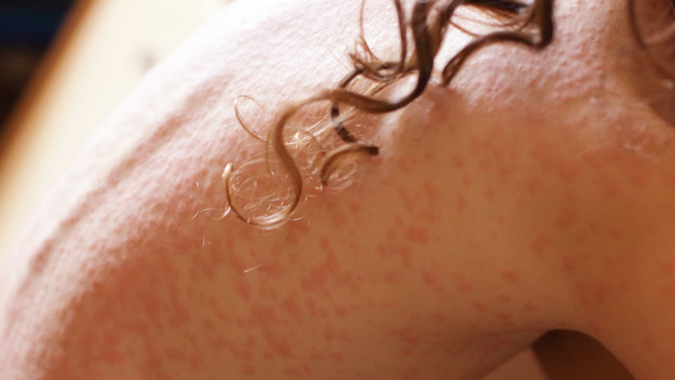 Sintomas de sarna humana: Doença contagiosa da pele causada por parasita