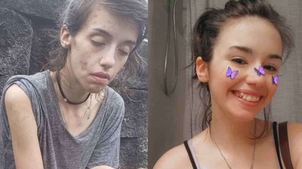 A impressionante imagem do 'antes e depois' de uma viciada em drogas
