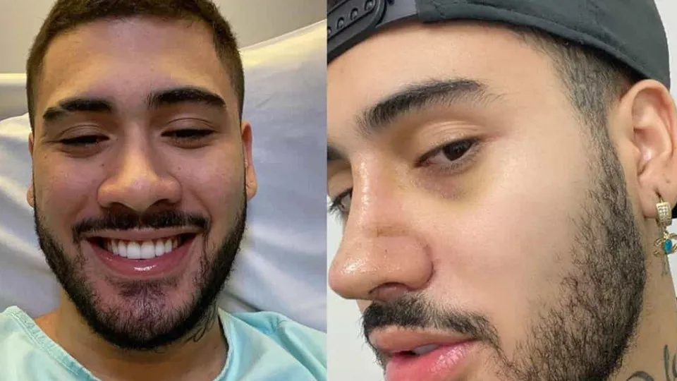 Kevinho mostra antes e depois de cirurgia ao nariz. "Mudou a minha vida"