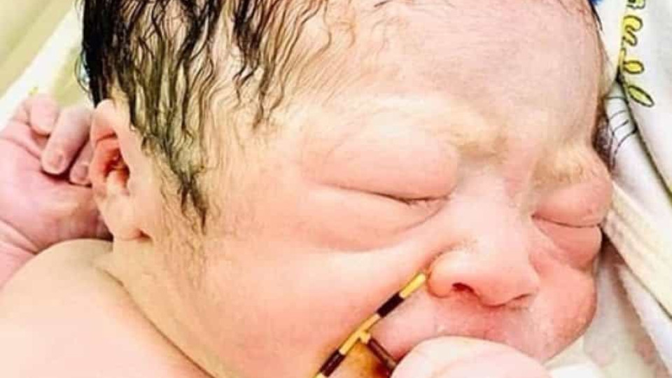 Bebé nasce agarrado ao DIU que a mãe tinha colocado. Foto torna-se viral