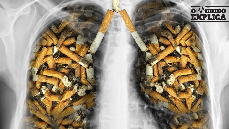 O médico explica: O cancro do pulmão continua a matar, pouse o cigarro