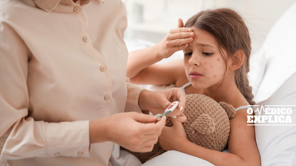 Médica explica tudo o que os pais devem saber acerca da varicela 