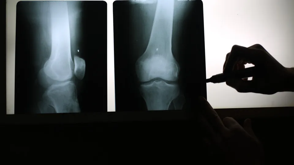 Novo tratamento para infeções ósseas cura a patologia e regenera o próprio osso
