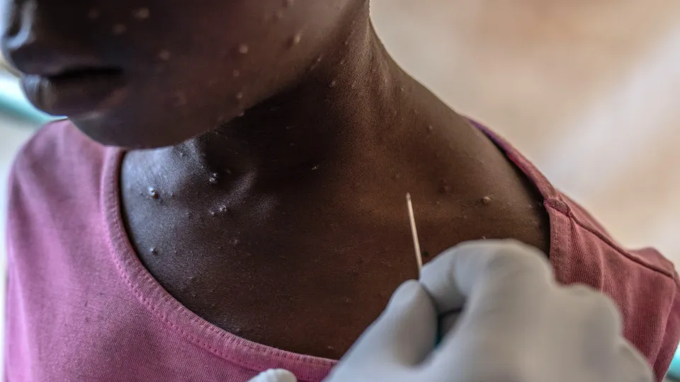 Tete regista primeiro caso de Mpox e eleva total para 82 em Moçambique