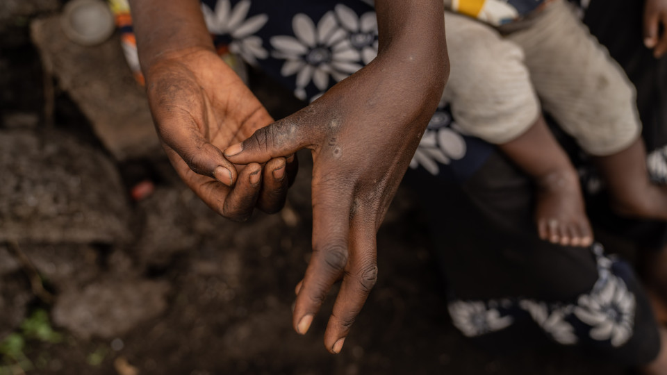 Mpox. Sem capacidade de testar Guiné, prepara plano de contingência