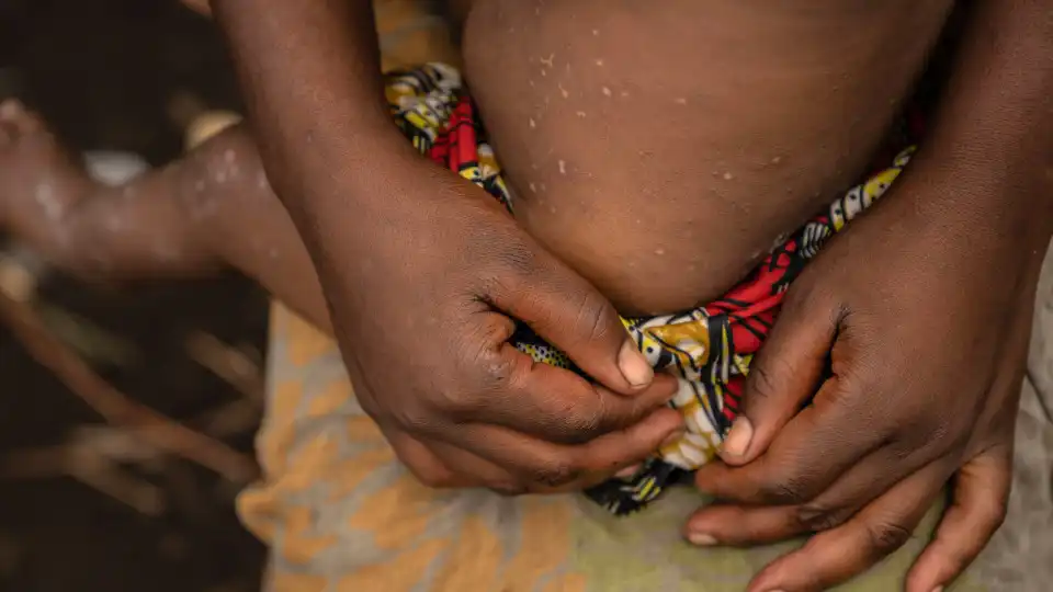 Mpox já matou 866 pessoas em África desde o início do ano