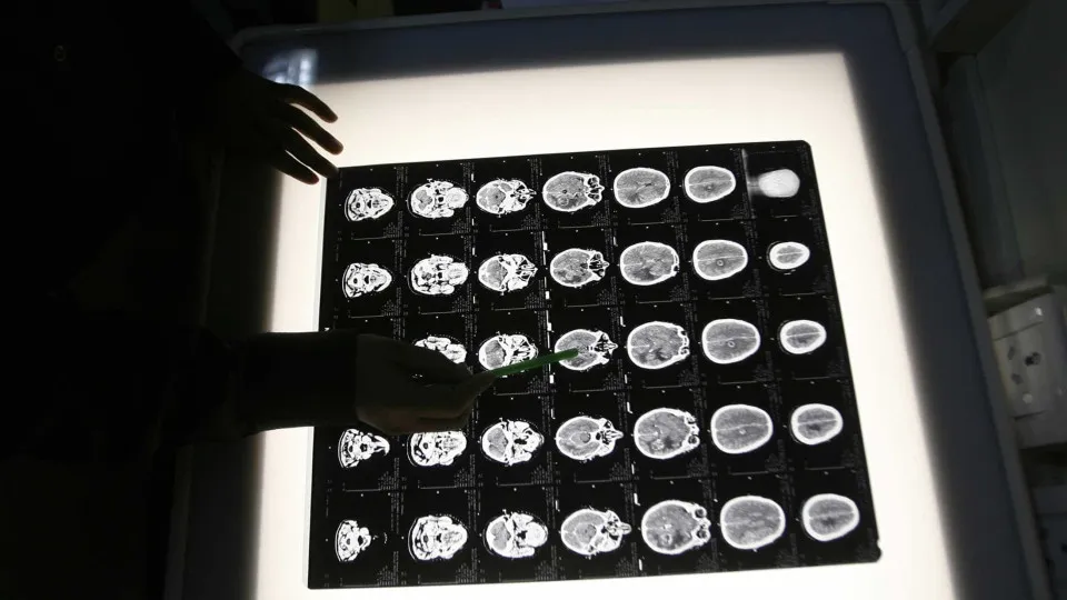 Cientistas descobrem solução para atrasar o Alzheimer