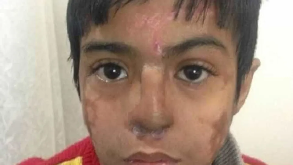 Jovem recebe implante de nariz criado na sua própria testa