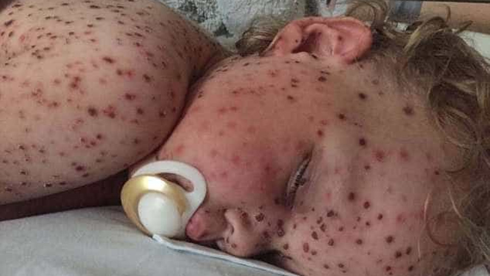 Médico de família não atendeu caso "mais grave de varicela"