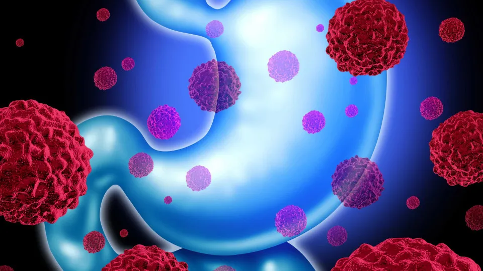 Estudo define orientações para lidar com síndrome rara de cancro gástrico