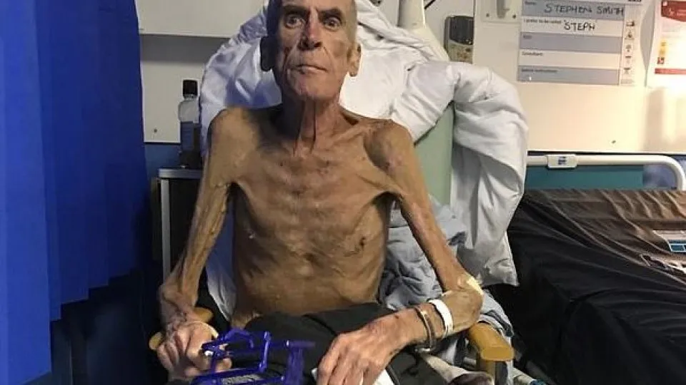 Morreu o homem que com 38 kg foi dado como apto para trabalhar