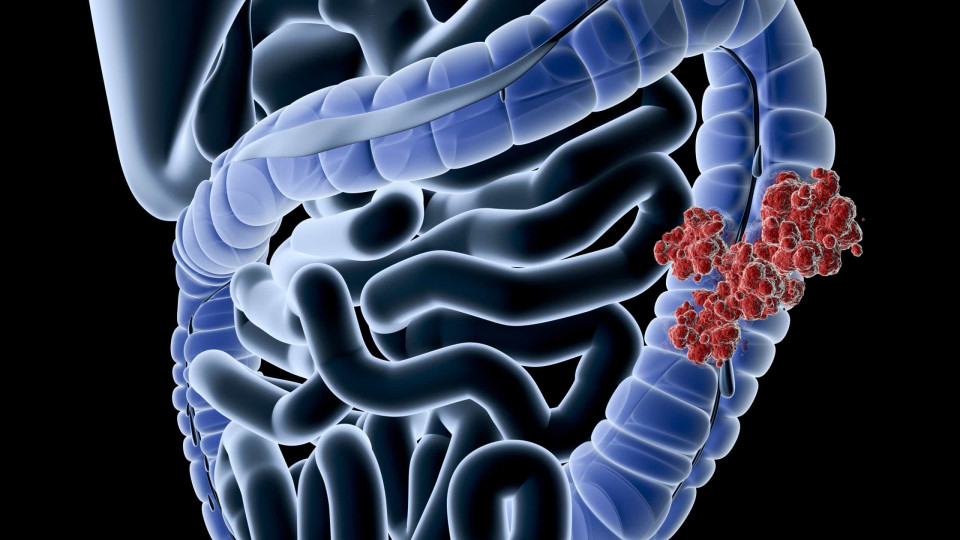 Cancro do intestino: Importância do rastreio na diminuição da incidência