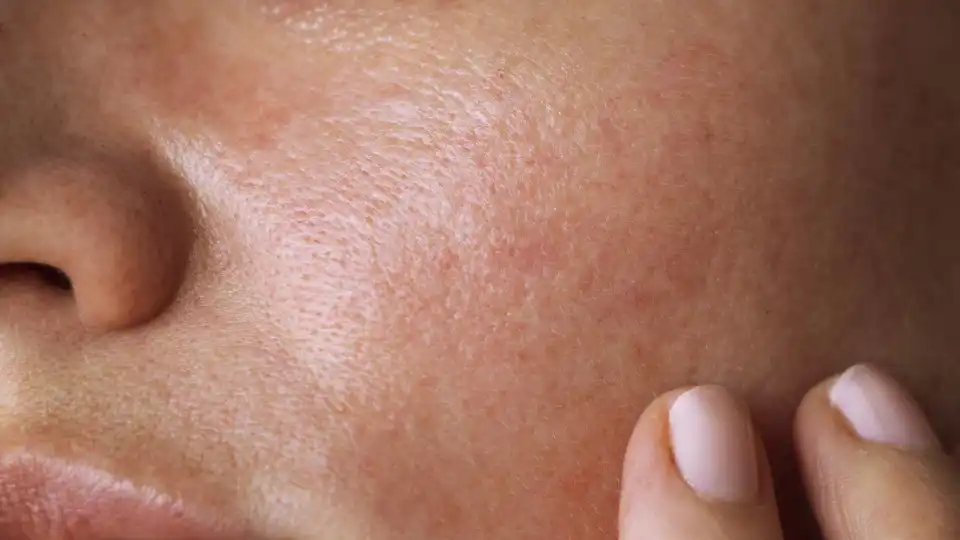 Há um ingrediente que reduz o melasma, as rugas e as manchas na pele