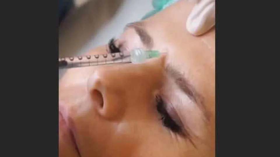 'Big Brother': Noélia coloca botox no rosto e mostra resultado final