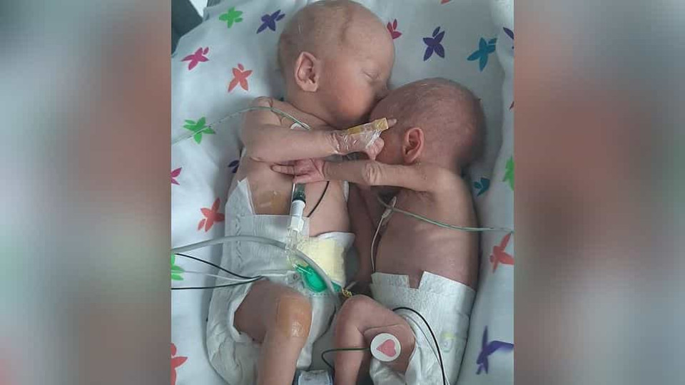 Gémeos separados à nascença abraçam-se e dão as mãos após duas semanas