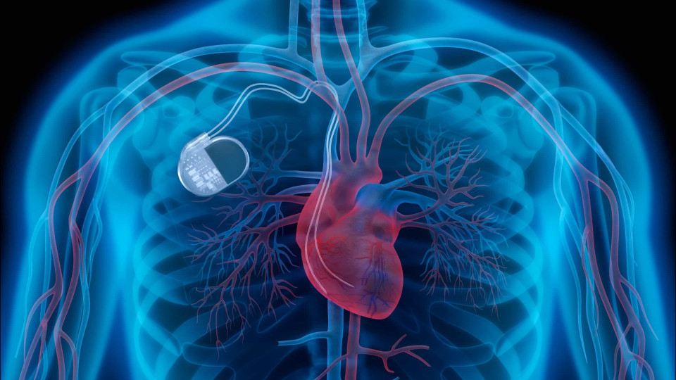 Nove principais dúvidas sobre pacemakers, médica explica