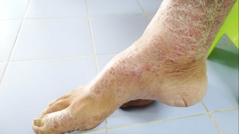  Esclerodermia: A 'viagem' do doente até chegar a um diagnóstico