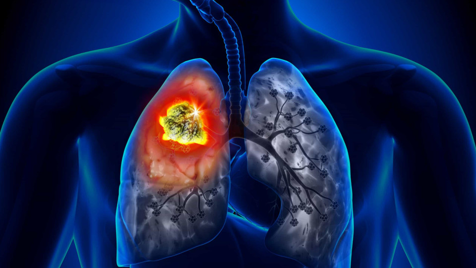 Cessação tabágica: Uma parte integrante do tratamento do cancro do pulmão