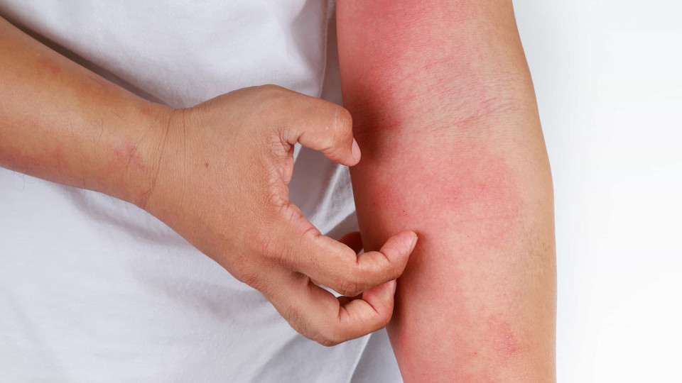 "Dermatite Atópica: só quem sente na pele é que a valoriza?"