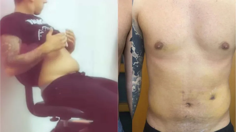 Em imagens: Fernando Daniel mostra antes e depois da lipoaspiração