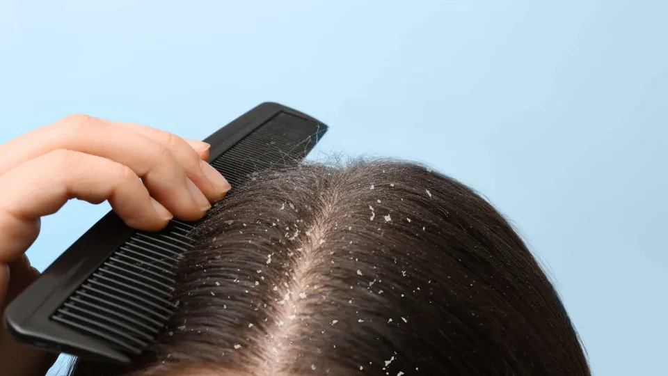 Oito dicas infalíveis para dizer adeus (de vez) à caspa