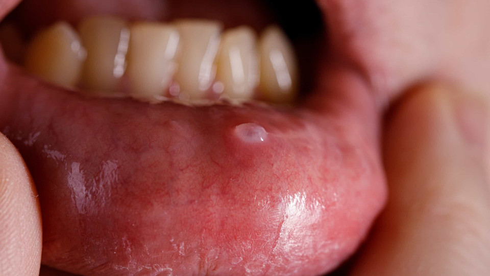 Cancro da boca: Quatro sinais de alerta que podem salvar-lhe a vida