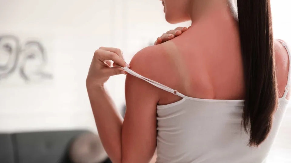 Quando é que as queimaduras solares devem ser tratadas no médico?