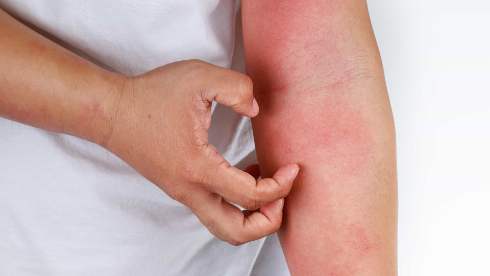 Dermatite atópica: A pele que 'grita' e não dorme (nem deixa dormir!)