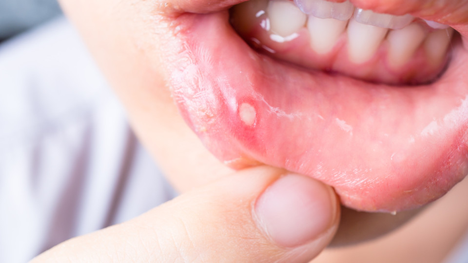 Fique atento a estes sintomas incomuns de cancro na boca