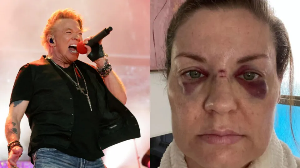 Axl Rose deixa mulher com rosto ferido após atirar microfone em concerto