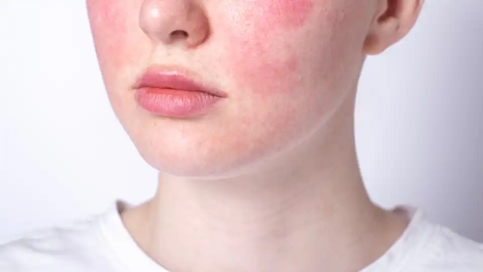 Do You Have Rosacea? Avoid 'Skincare' Products With These Ingredients