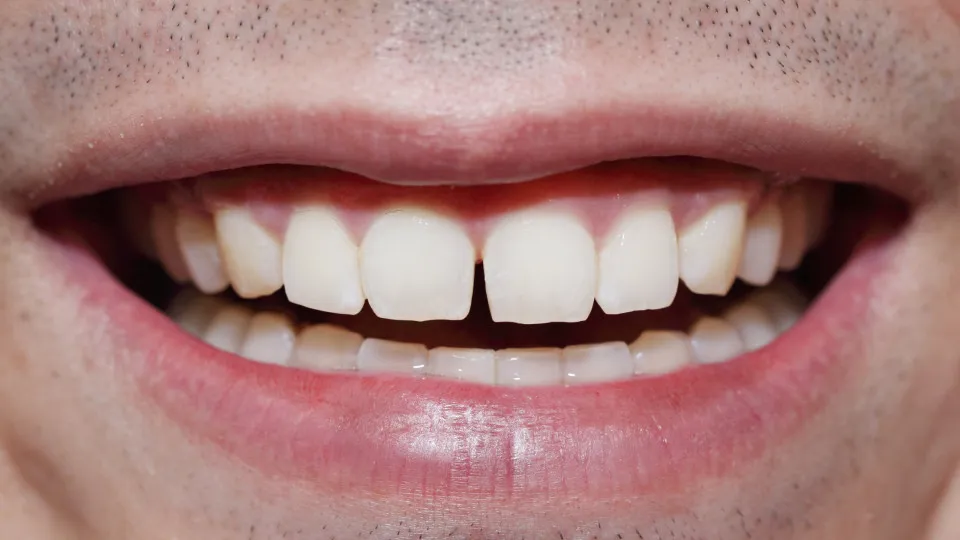 As razões que fazem com que tenha pequenos espaços entre os dentes