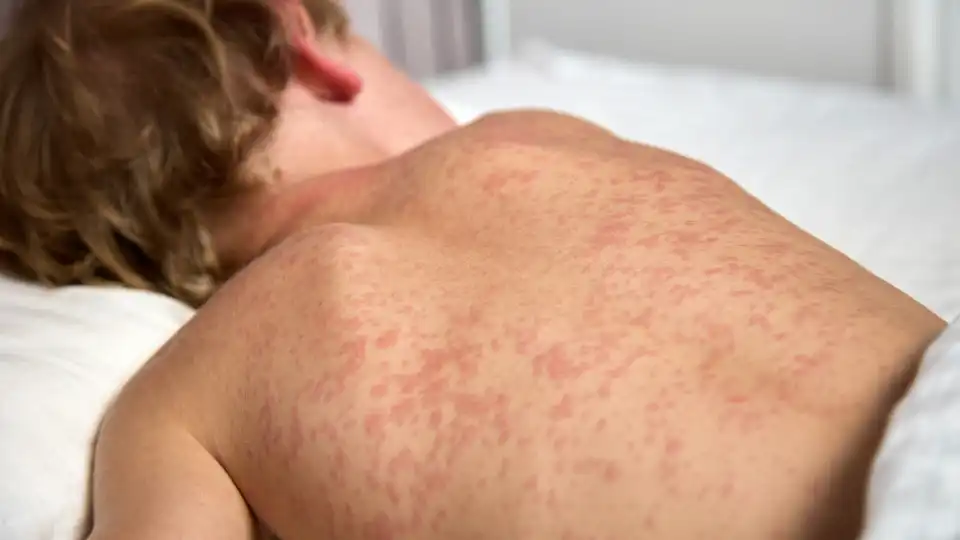 Portugal with 20 confirmed cases of measles