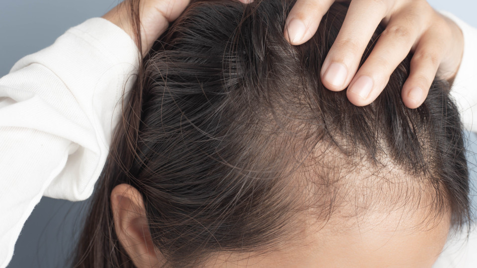 Dermatologista revela os principais motivos para estar a perder cabelo