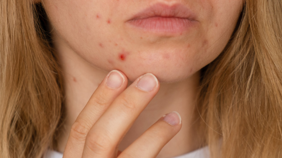 Cinco truques naturais para limpar a pele e evitar os pontos negros