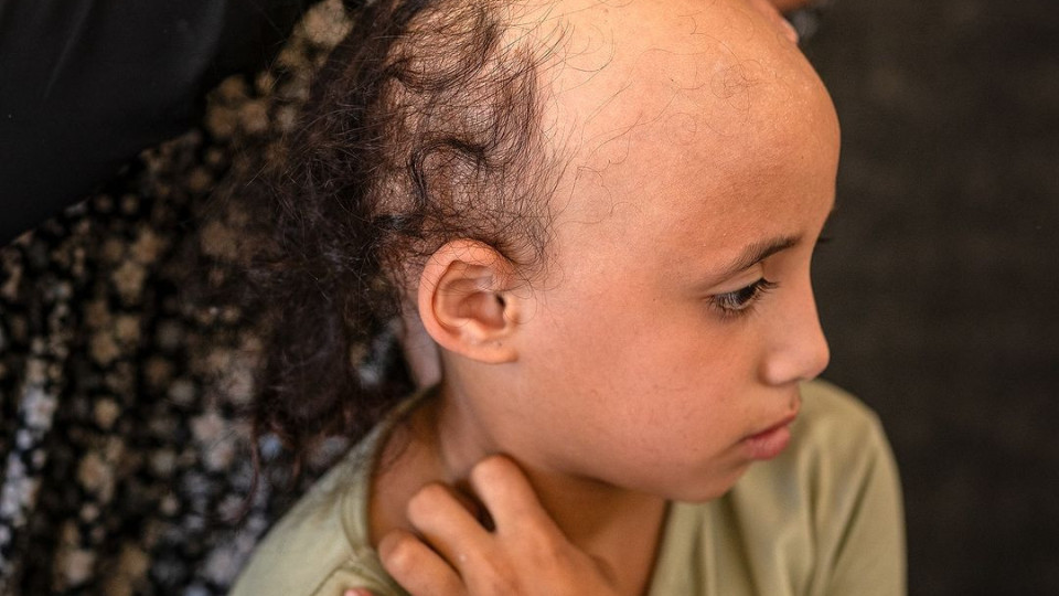 "Medo". Menina de 8 anos perde cabelo devido ao stress da guerra em Gaza