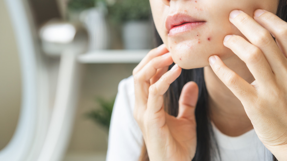 Usar pasta dos dentes nas borbulhas faz com que desapareçam? 