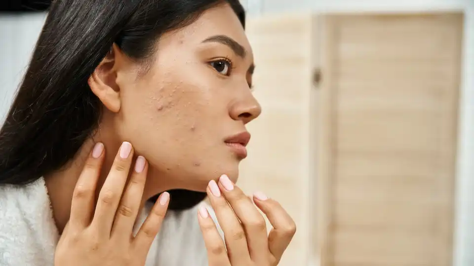 Tem acne? É melhor evitar produtos de 'skincare' com estes ingredientes