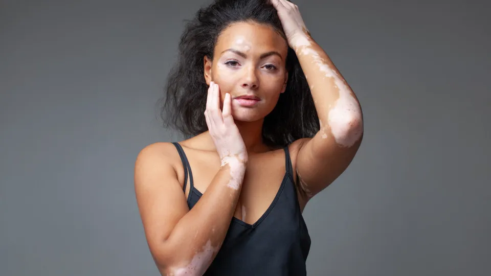 Vitiligo