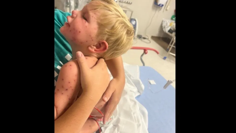 Menino de 2 anos picado 150 vezes por vespas. Está nos cuidados intensivos