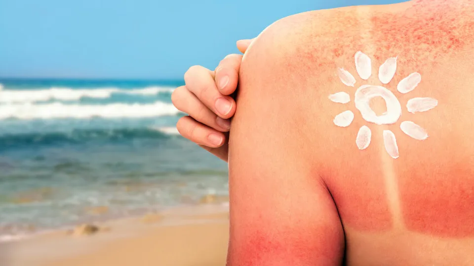 Sunburn tattoos, mulher queimada