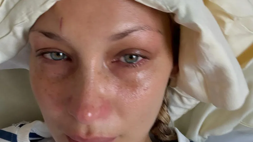 Doença de Lyme. Bella Hadid partilha imagens no hospital