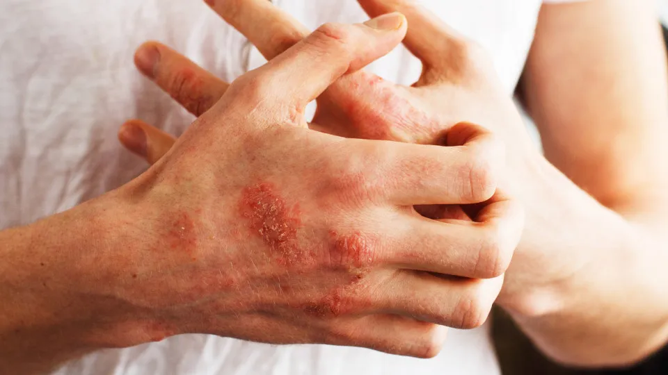 A psoríase também pode atingir as unhas? Saiba como tratar o problema