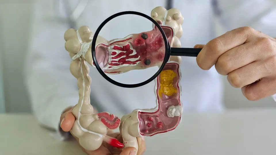 Muita atenção! Este sintoma pouco falado pode indicar cancro colorretal